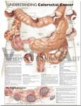 Understanding Colorectal Cancer Anatomical Chart